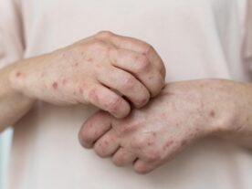 skin-allergy-person-s-arm-hanseníase-pandemia