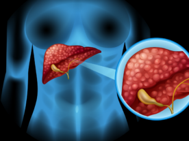 tumor de pancreas