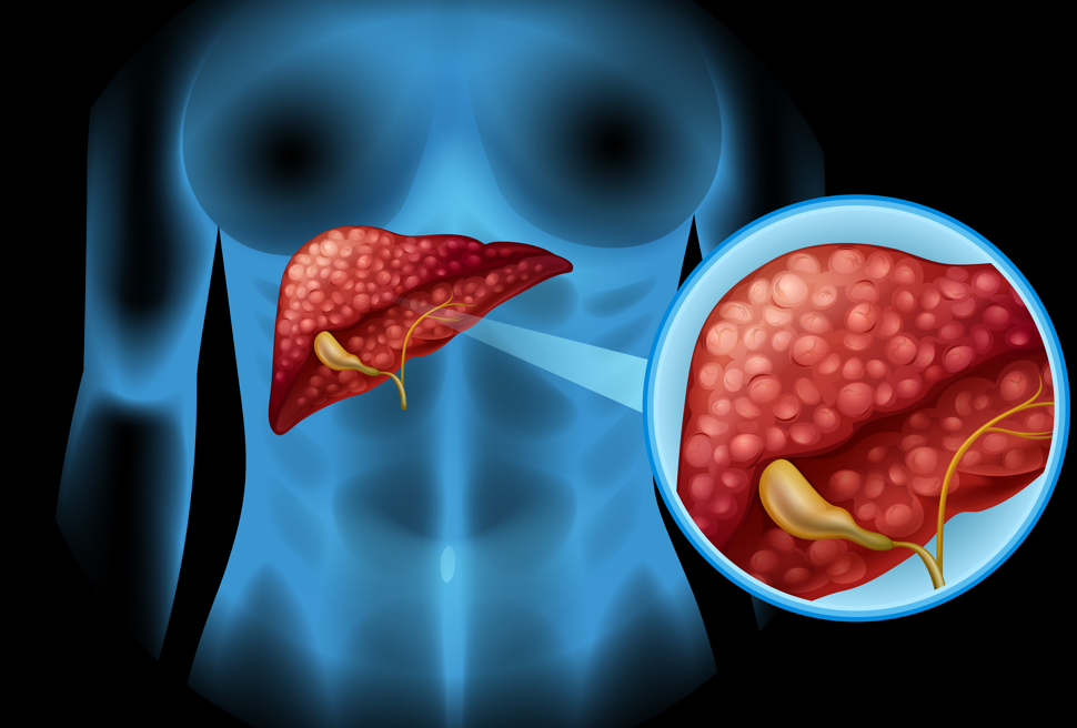 Entenda o tumor de pâncreas, doença que matou Léo Batista